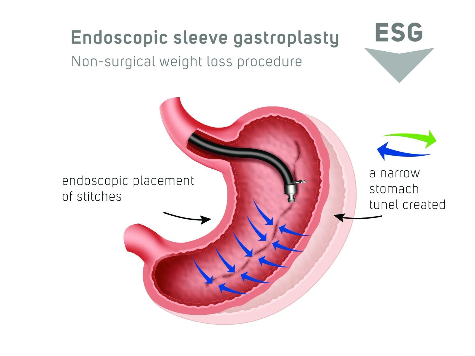 Endoscopic Sleeve Gastroplasty