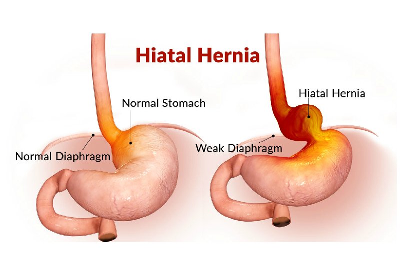 Hiatal Hernia Repair