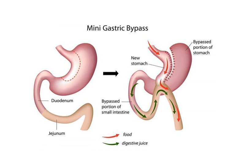 Mini Gastric Bypass Surgery