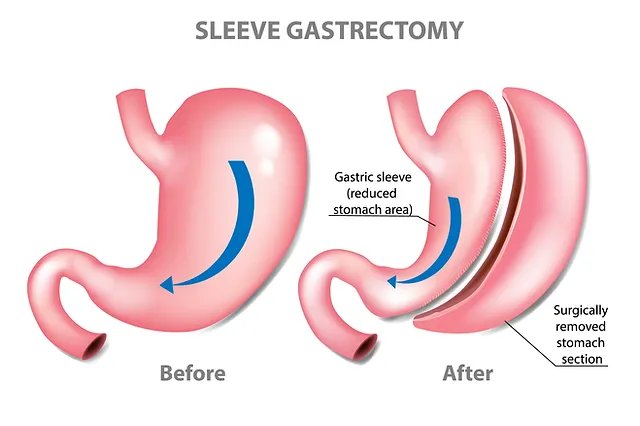 Single Incision Gastric Sleeve